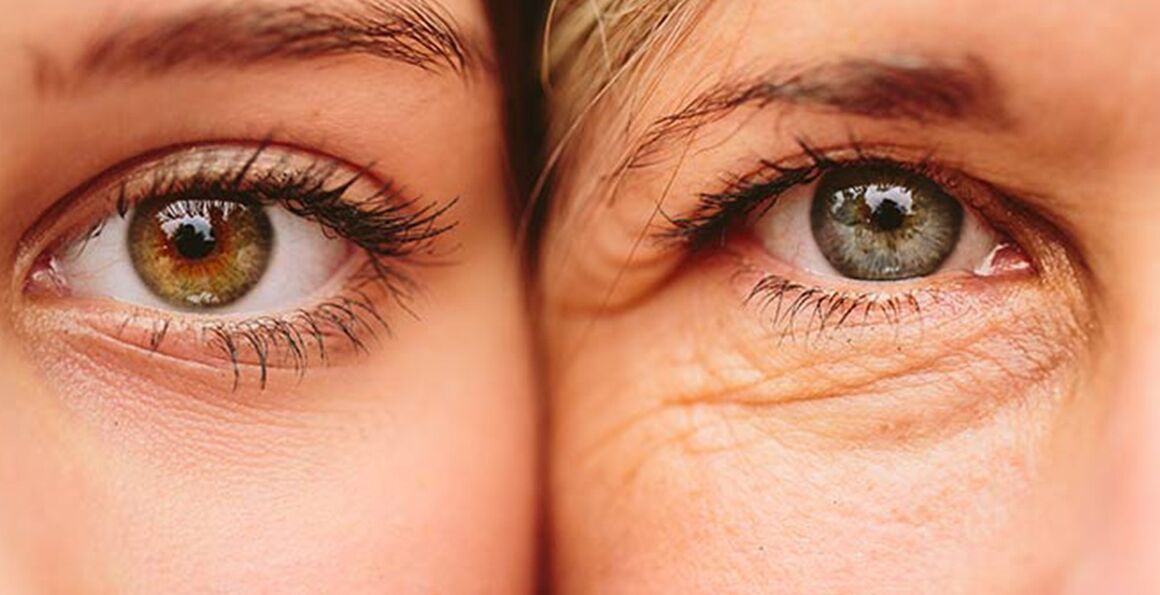 Εξωτερικά σημάδια γήρανσης του δέρματος γύρω από τα μάτια σε δύο γυναίκες διαφορετικής ηλικίας